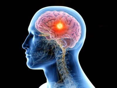 TMS (Transcranial Magnetic Stimulation) Therapy